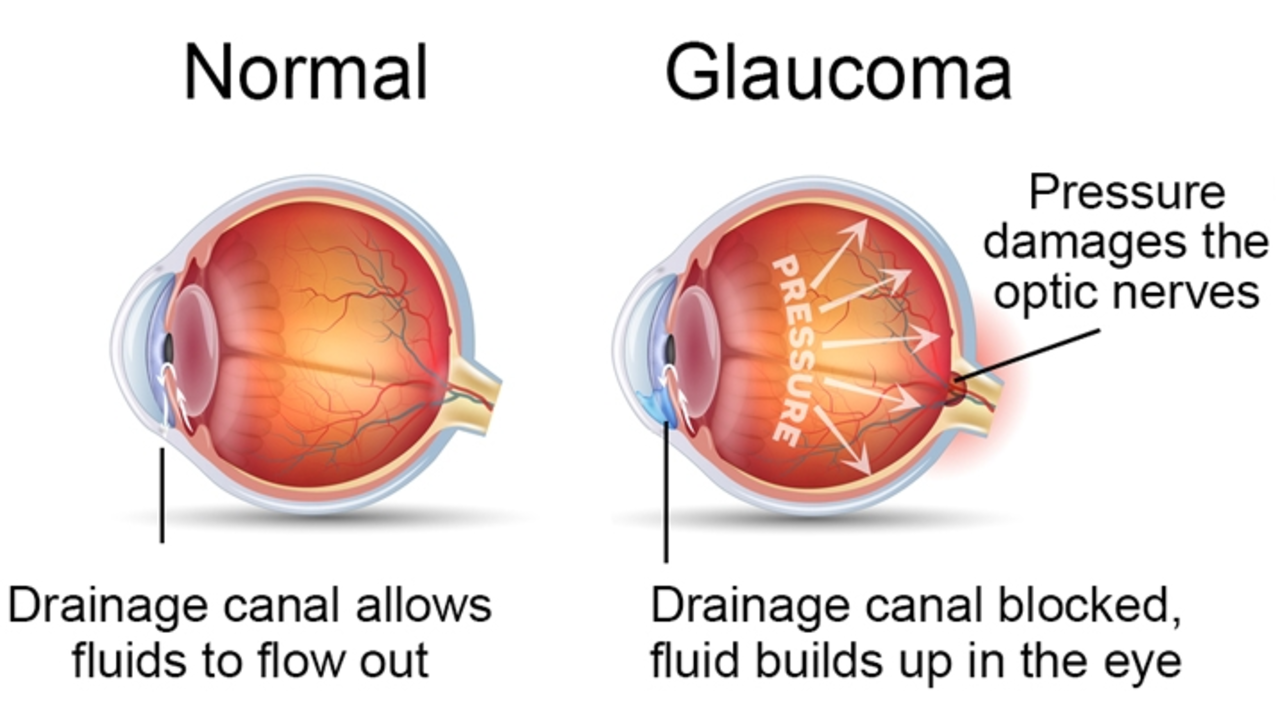Glaucoma Symptoms: Early Warning Signs to Watch Out For