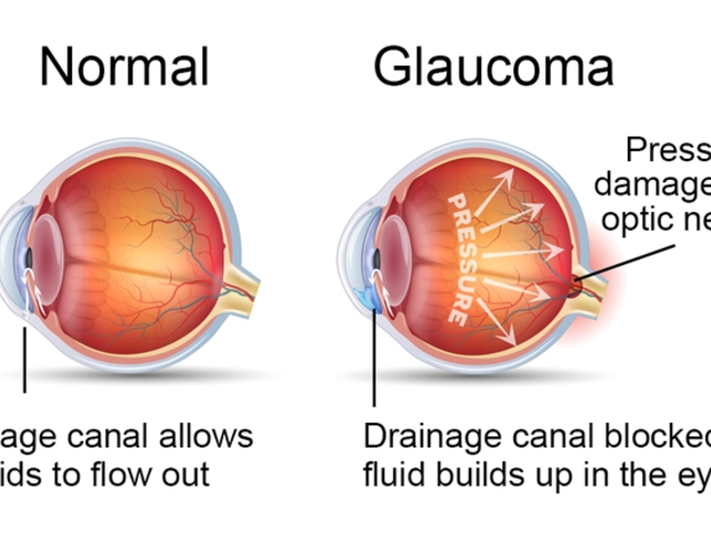Glaucoma Symptoms: Early Warning Signs to Watch Out For