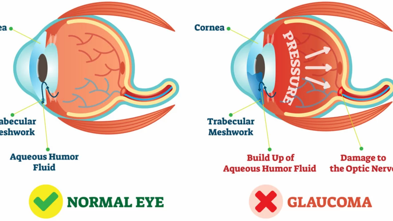 Understanding Glaucoma Surgery: What to Expect During and After the Procedure